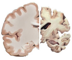 Cross section of a healthy brain (left) and a brain with severe Alzheimer's disease (right)